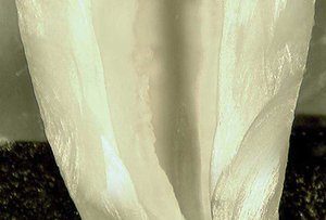 Gentle Wave Procedure