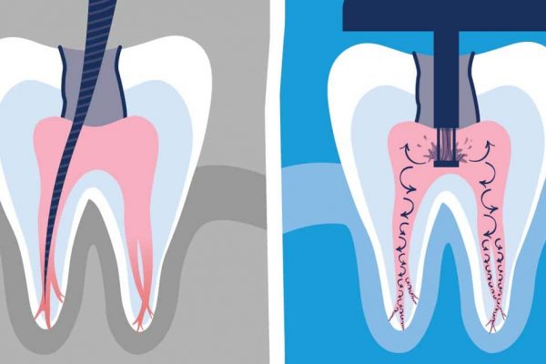 Gentle Wave Procedure